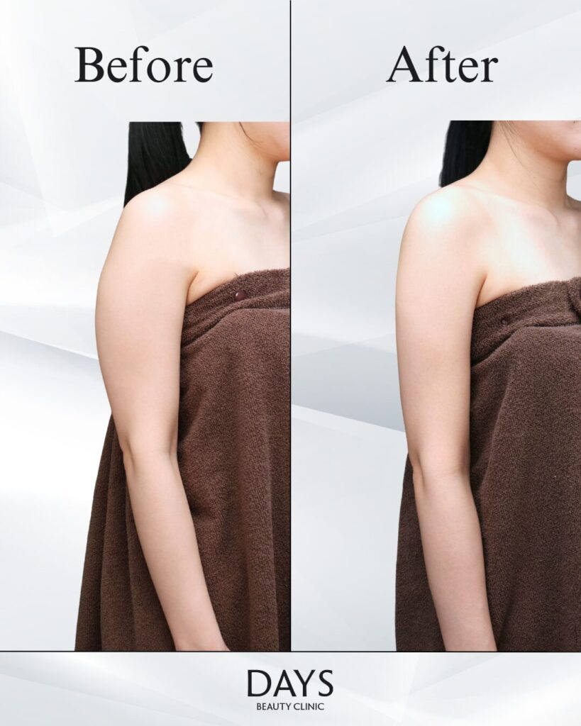 二の腕脂肪吸引　症例　20代女性